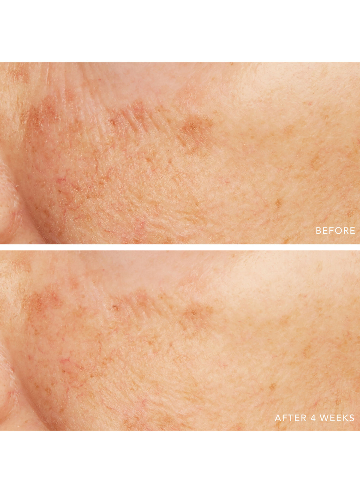 Caviar Lime Acid Peel