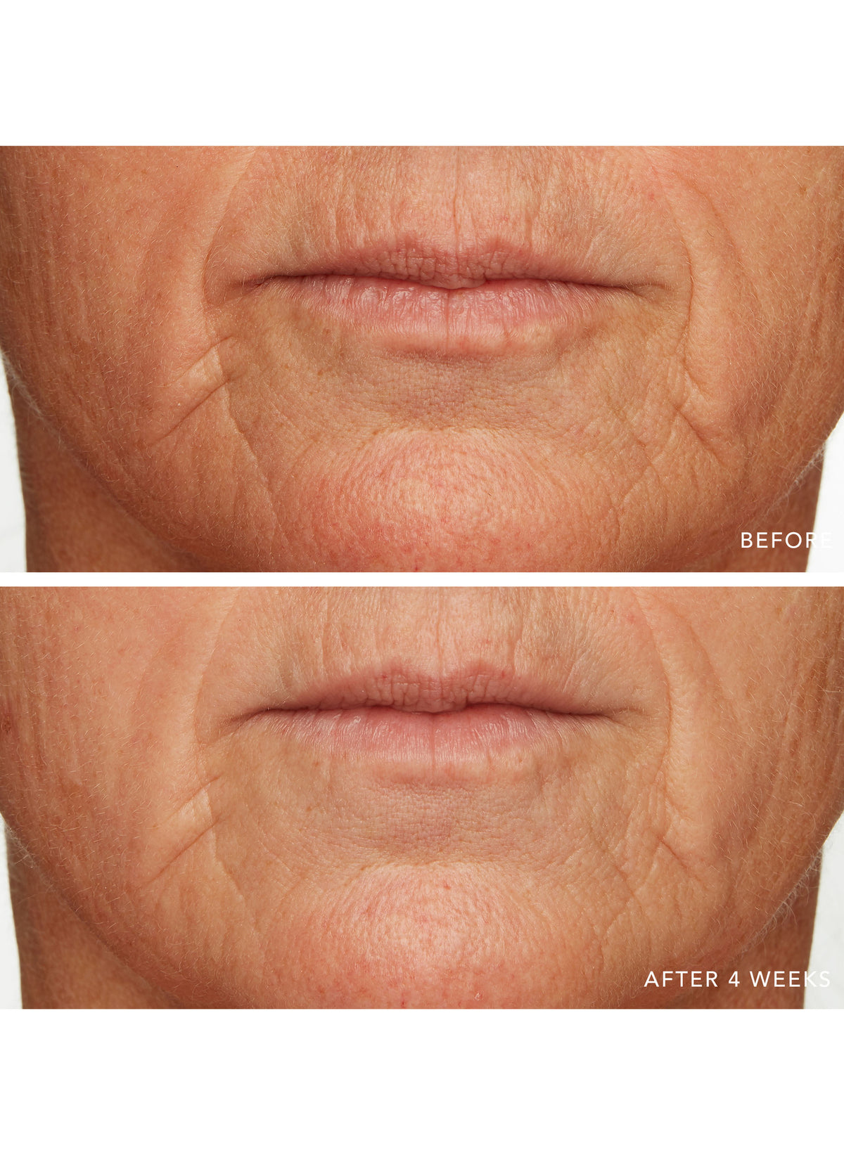 Caviar Lime Acid Peel